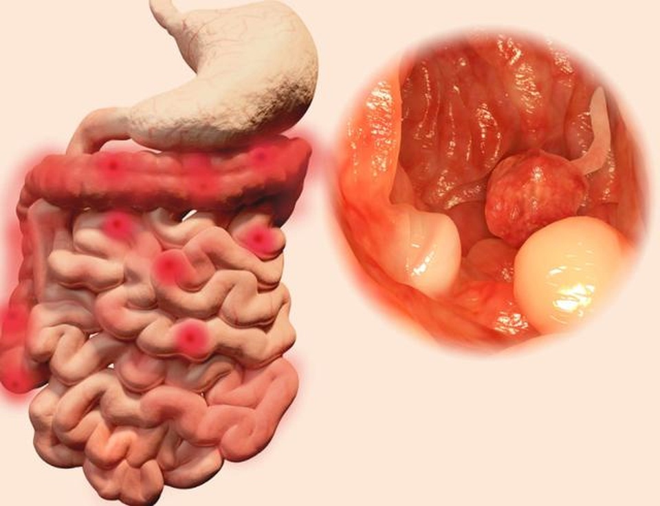 Đi vệ sinh có 3 dấu hiệu này, coi chừng ung thư ruột gõ cửa - 2 Đi vệ sinh có 3 dấu hiệu này, coi chừng ung thư ruột gõ cửa - 2