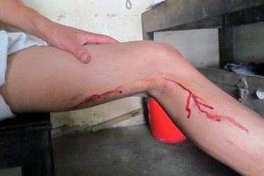 Bị lợn rừng tấn công, hai người phải khâu nhiều mũi