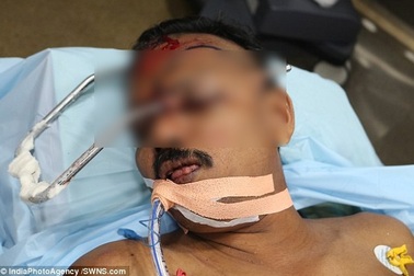 Bị thanh thép đâm xuyên hộp sọ, người đàn ông sống sót thần kỳ