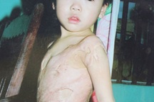 Di chứng nặng nề của bé Kiều Trang sau ca bỏng toàn thân