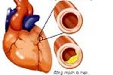 Phòng và điều trị mỡ máu cao