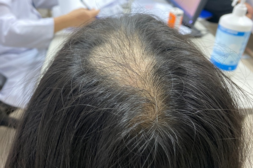 Bé gái 10 tuổi “nghiện” giật tóc trụi cả đỉnh đầu - 1 Bé gái 10 tuổi “nghiện” giật tóc trụi cả đỉnh đầu - 1