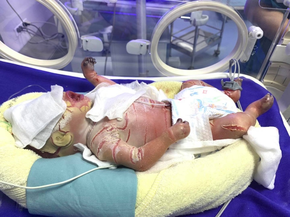 Bé trai sinh non mắc bệnh hiếm gặp, màng trắng bao bọc toàn thân - 1 Bé trai sinh non mắc bệnh hiếm gặp, màng trắng bao bọc toàn thân - 1