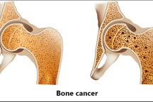 Nguyên nhân gây ung thư xương
