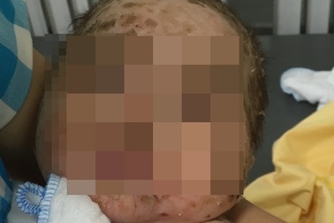 Tắm lá chữa thủy đậu, bé trai nhiễm độc, lở loét toàn thân