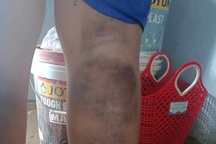 Cảnh cáo giáo viên chủ nhiệm đánh học sinh bầm tím 2 chân