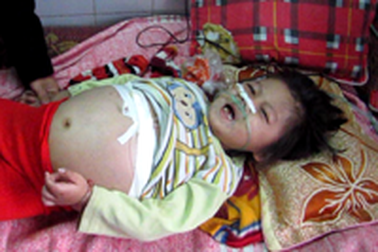 Tình cảnh hiểm nghèo của bé gái người dân tộc Chứt 