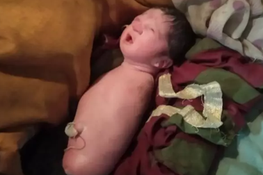 Bé gái Ấn Độ chào đời không có cả 2 tay 2 chân