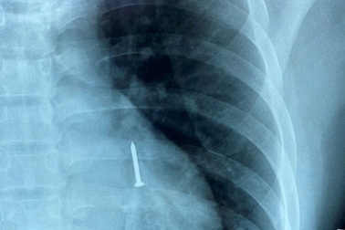 Cứu thợ hồ bị đinh sắt dài 3cm rơi vào phổi khi đang ngậm trong miệng