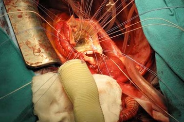 Mổ cấp cứu vì đau bụng mơ hồ