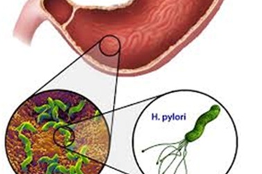 Viêm loét dạ dày có dễ gây ung thư?