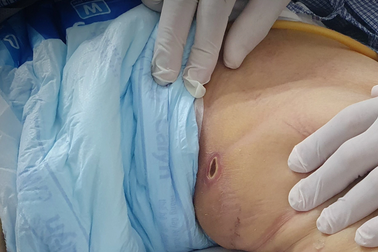 Nhiễm trùng huyết, suy hô hấp nguy kịch từ một nốt mò đốt