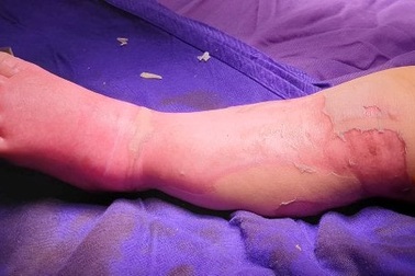 Bé 9 tháng tuổi tử vong vì sốc nhiễm khuẩn do chữa bỏng bằng thuốc nam