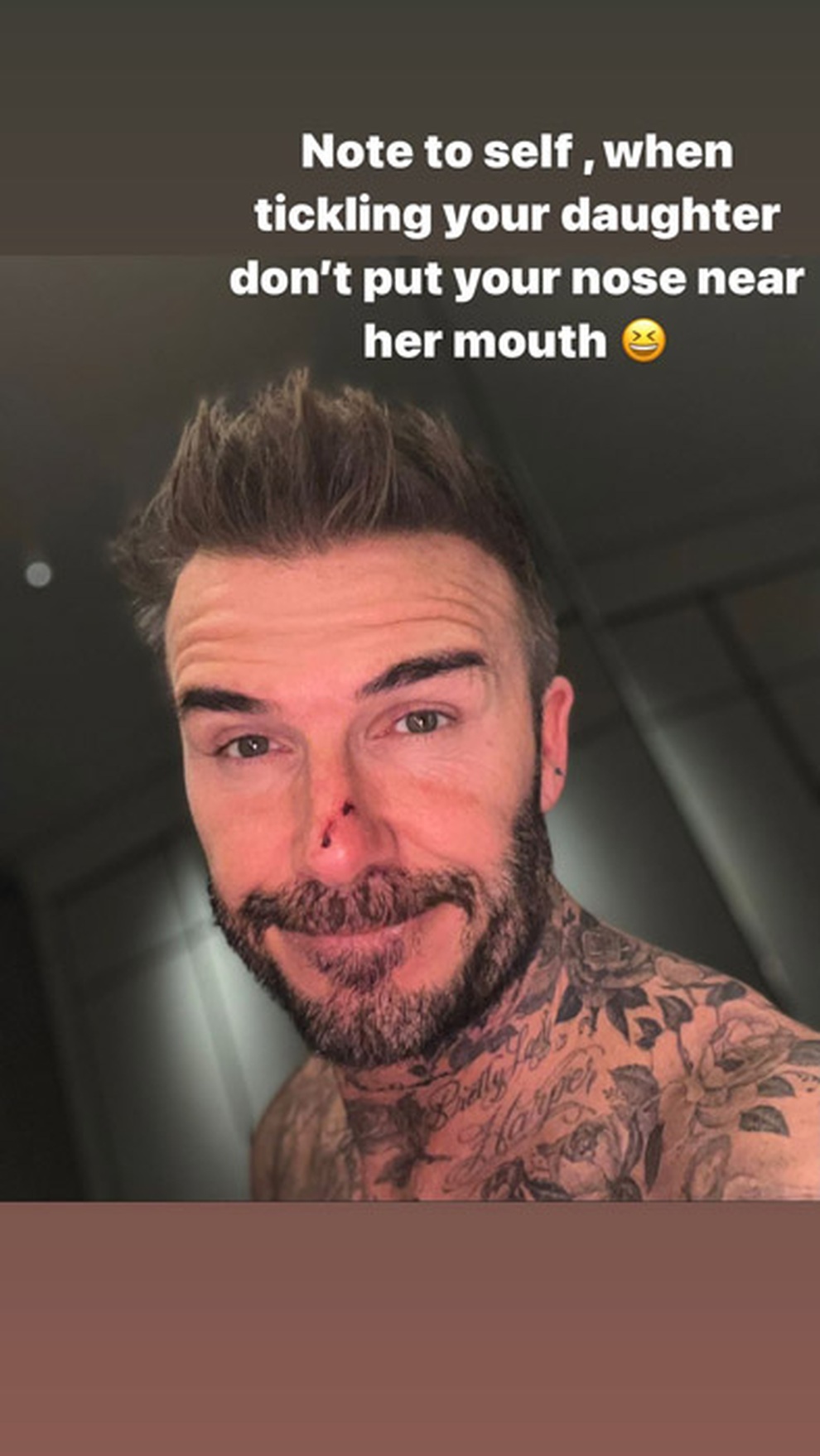 David Beckham gặp phản ứng khi đăng ảnh bị con gái cắn chảy máu mũi - 1 David Beckham gặp phản ứng khi đăng ảnh bị con gái cắn chảy máu mũi - 1