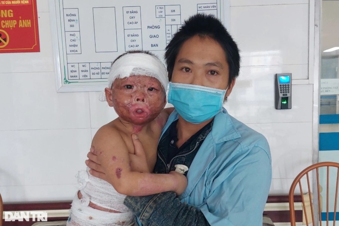 Bạn đọc Dân trí giúp đỡ bé 3 tuổi bị bỏng lửa hơn 500 triệu đồng - 2 Bạn đọc Dân trí giúp đỡ bé 3 tuổi bị bỏng lửa hơn 500 triệu đồng - 2
