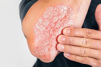 Tự điều trị bệnh da, người đàn ông nằm cáng vì tổn thương khớp nghiêm trọng