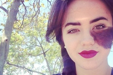 Vẻ đẹp rạng ngời của nữ vũ công trẻ bị chàm nửa mặt