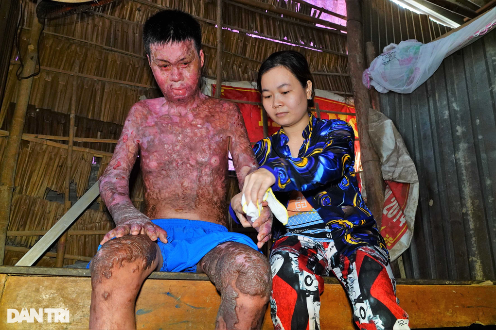 Người đàn ông bị bỏng hơn 90%, chỉ cầu mong sự sống để nuôi con - 1 Người đàn ông bị bỏng hơn 90%, chỉ cầu mong sự sống để nuôi con - 1