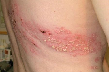 Chịu di chứng hậu Zona 25 năm do lỡ thời gian "vàng" điều trị