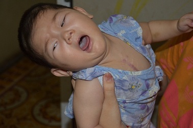 Tiếng khóc xé lòng của bé gái 9 tháng tuổi mắc tim bẩm sinh phức tạp