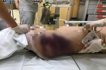 Phẫn nộ về cái chết của bé gái nghi bị người tình của bố bạo hành