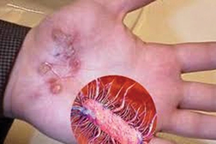 Bé gái 9 tuổi nhiễm "vi khuẩn ăn thịt"