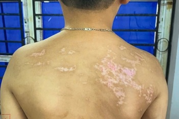 Khởi tố ông bố bạo hành con ruột gây thương tích 36%