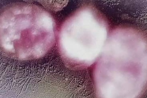 “Siêu vi khuẩn” kháng mọi loại thuốc cũng có tại Việt Nam