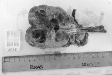 Đái ra máu- Cẩn thận bệnh nguy hiểm