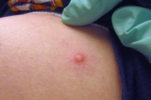 Người mắc bệnh đậu mùa khỉ có dấu hiệu đặc trưng gì?