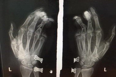 Điện thoại phát nổ khi đang sạc pin, thanh niên bị dập nát bàn tay