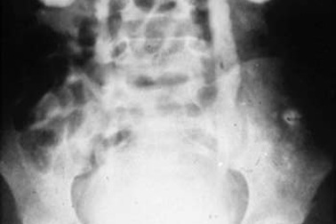 Phẫu thuật nội soi thành công hai trường hợp thận ứ nước