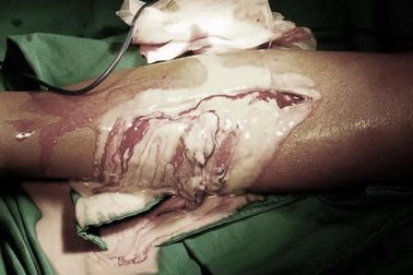 Thầy lang cắt lể “máu độc” ở chân, bệnh nhi suýt mất mạng