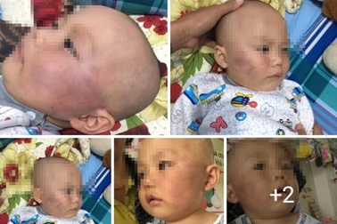 Bảo mẫu tát liên tiếp bé trai 19 tháng, nói dối là… ngã cầu thang