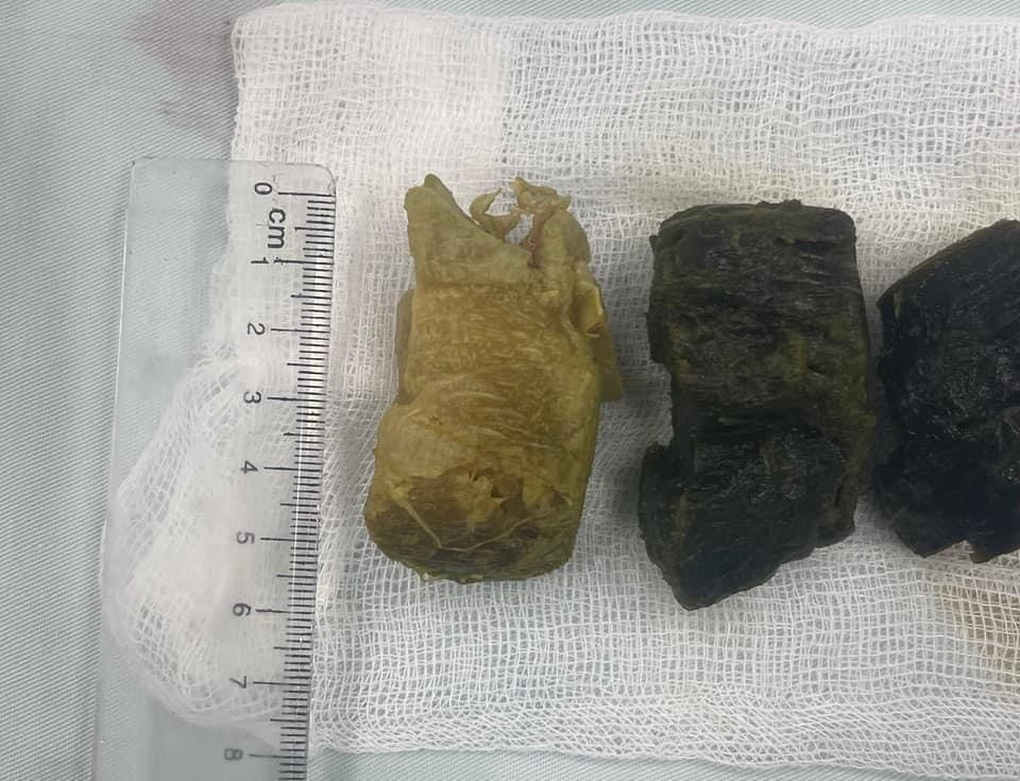 Ăn măng khô không biết điều này dễ rước bệnh vào người - 1 Ăn măng khô không biết điều này dễ rước bệnh vào người - 1