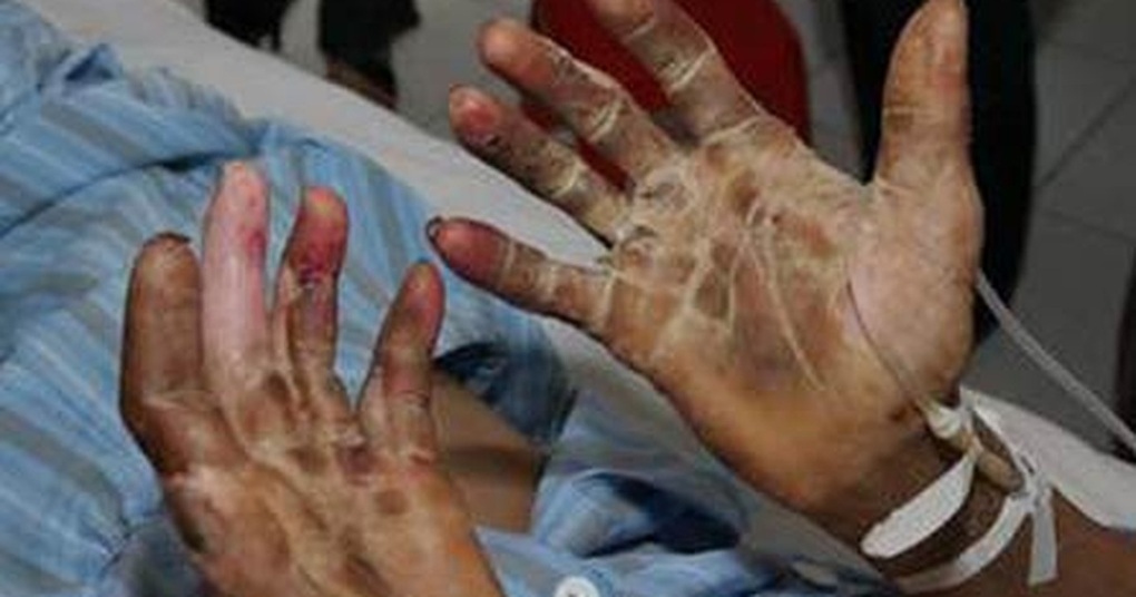 Hai người thập tử nhất sinh vì căn bệnh cực nguy hiểm lây từ lợn - 1