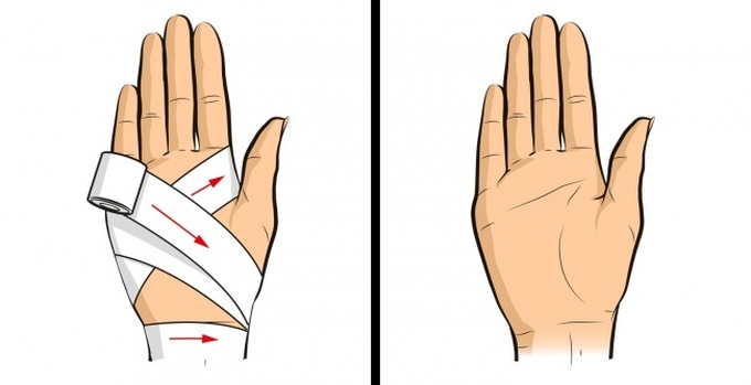 Kiểu băng trên được gọi là băng số 8 để cố định những khớp nhỏ hơn hoặc để chữa vết thương.