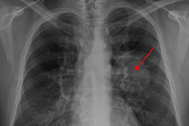 Israel phát triển phương pháp mới chữa trị ung thư