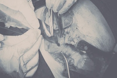 Cứu sống bệnh nhân bị đâm thấu tim, sốc mất máu nặng