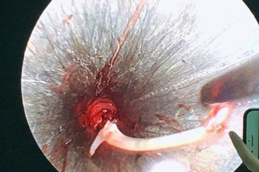 Người đàn ông suýt mất mạng vì tin lời thầy mo uống “nước thần” để chữa hóc xương cá