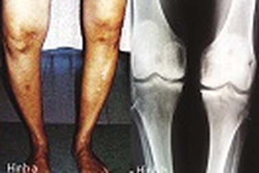 Collagen type II không biến tính: Liệu pháp mới trong điều trị thoái hóa khớp