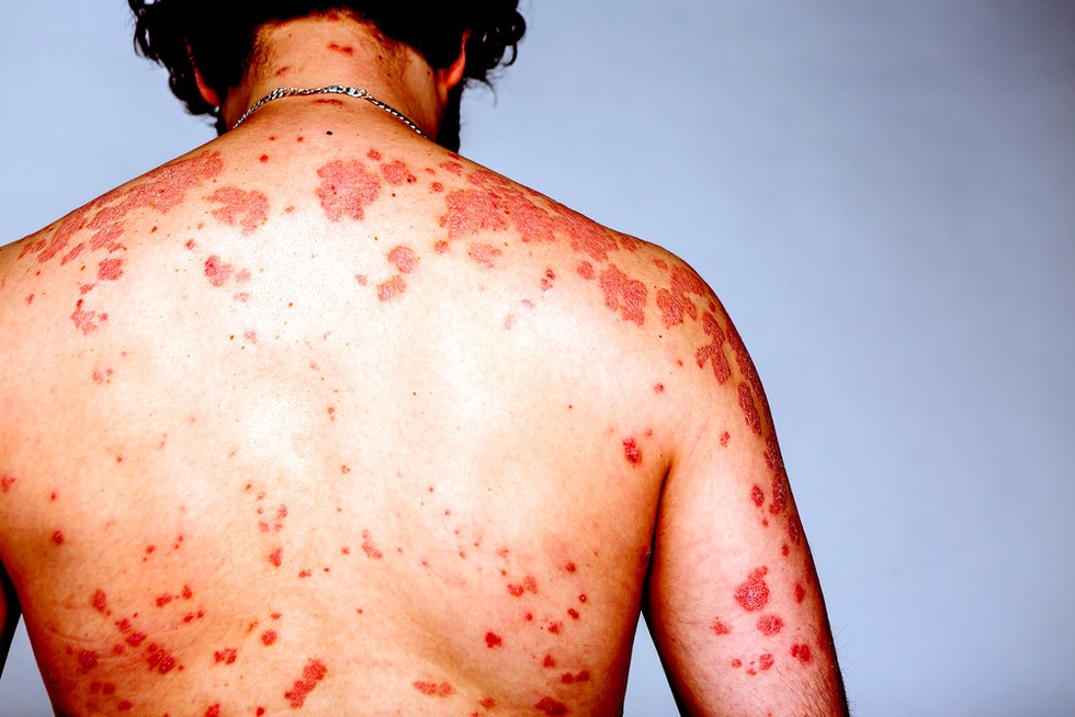 Người thứ 7 khỏi HIV: Sắp tới chương cuối của căn bệnh thế kỷ? - 4 Người thứ 7 khỏi HIV: Sắp tới chương cuối của căn bệnh thế kỷ? - 4