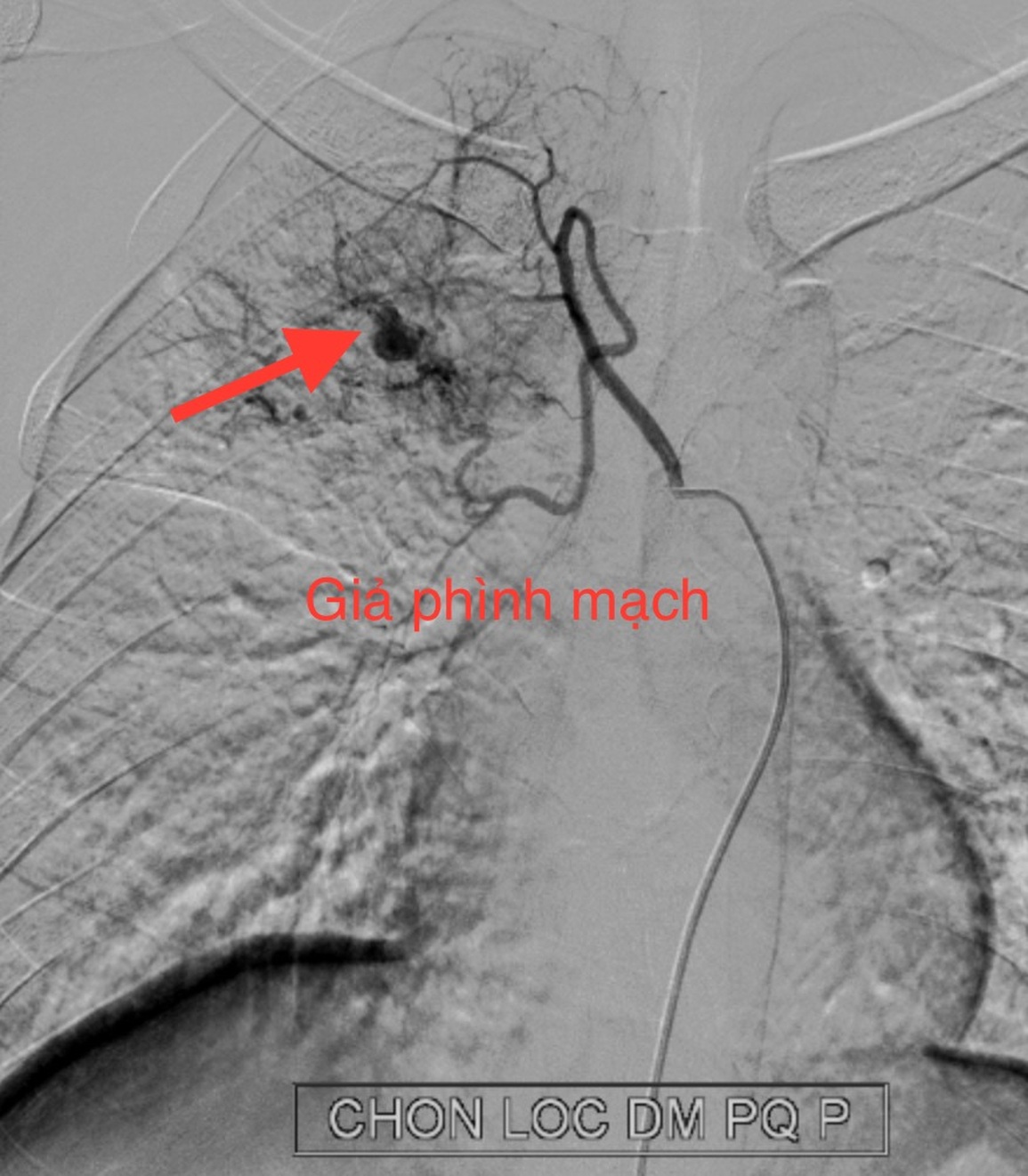 Cấp cứu thành công bệnh nhân lao mắc Covid-19 ho ra máu ồ ạt - 1 Cấp cứu thành công bệnh nhân lao mắc Covid-19 ho ra máu ồ ạt - 1