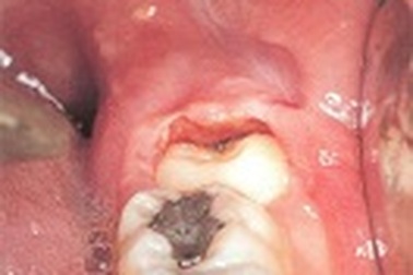 Những tác hại khôn lường do răng khôn mọc lệch