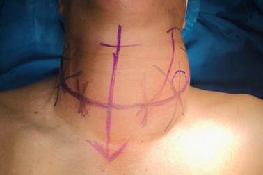 Khối u to như quả bưởi gây khó thở vì trì hoãn mổ 3 năm