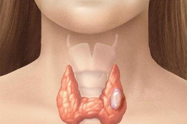 Nhân thùy trái tuyến giáp tirads 3 có nguy hiểm không?