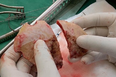 Vỡ sọ vì rơi từ lầu 2, người phụ nữ may mắn thoát chết