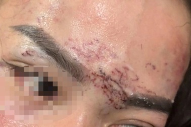 Một phụ nữ ở Cà Mau tố bị xăm lên mặt nghi do ghen tuông