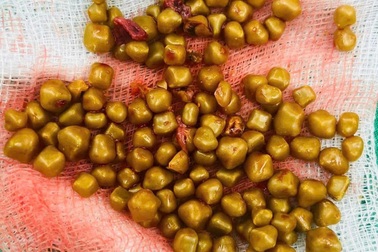 Hy hữu nữ bệnh nhân có hơn 100 viên sỏi trong túi mật