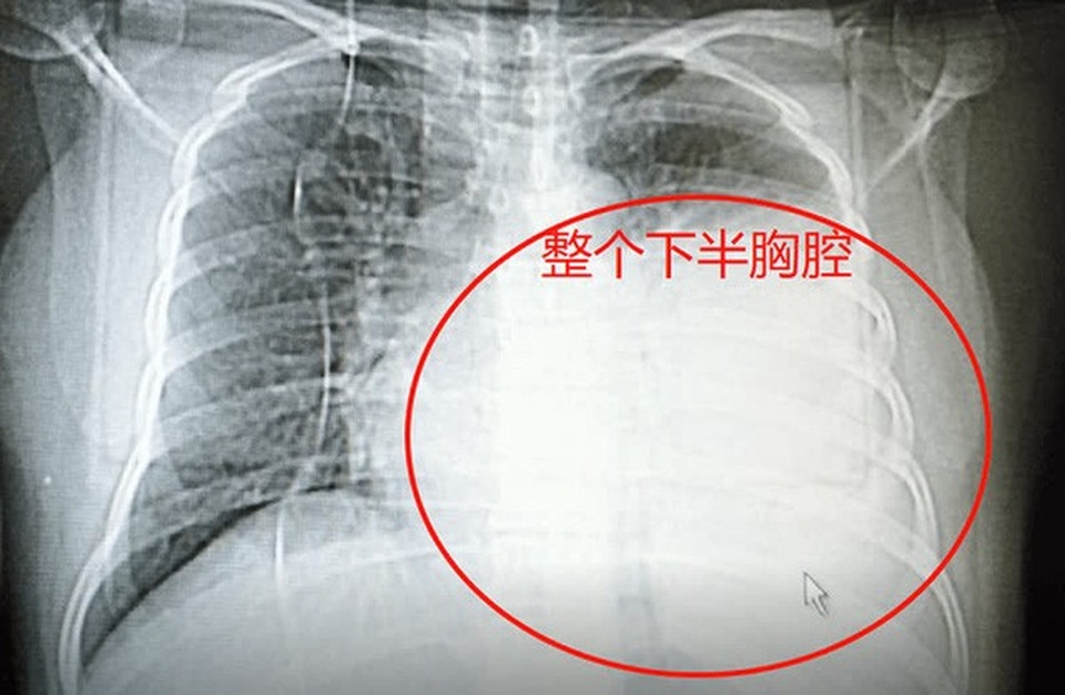 Ho khan lâu ngày, cô giáo giật mình phát hiện ung thư - 1 Ho khan lâu ngày, cô giáo giật mình phát hiện ung thư - 1